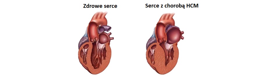 Zdravá a postižená tkáň srdce